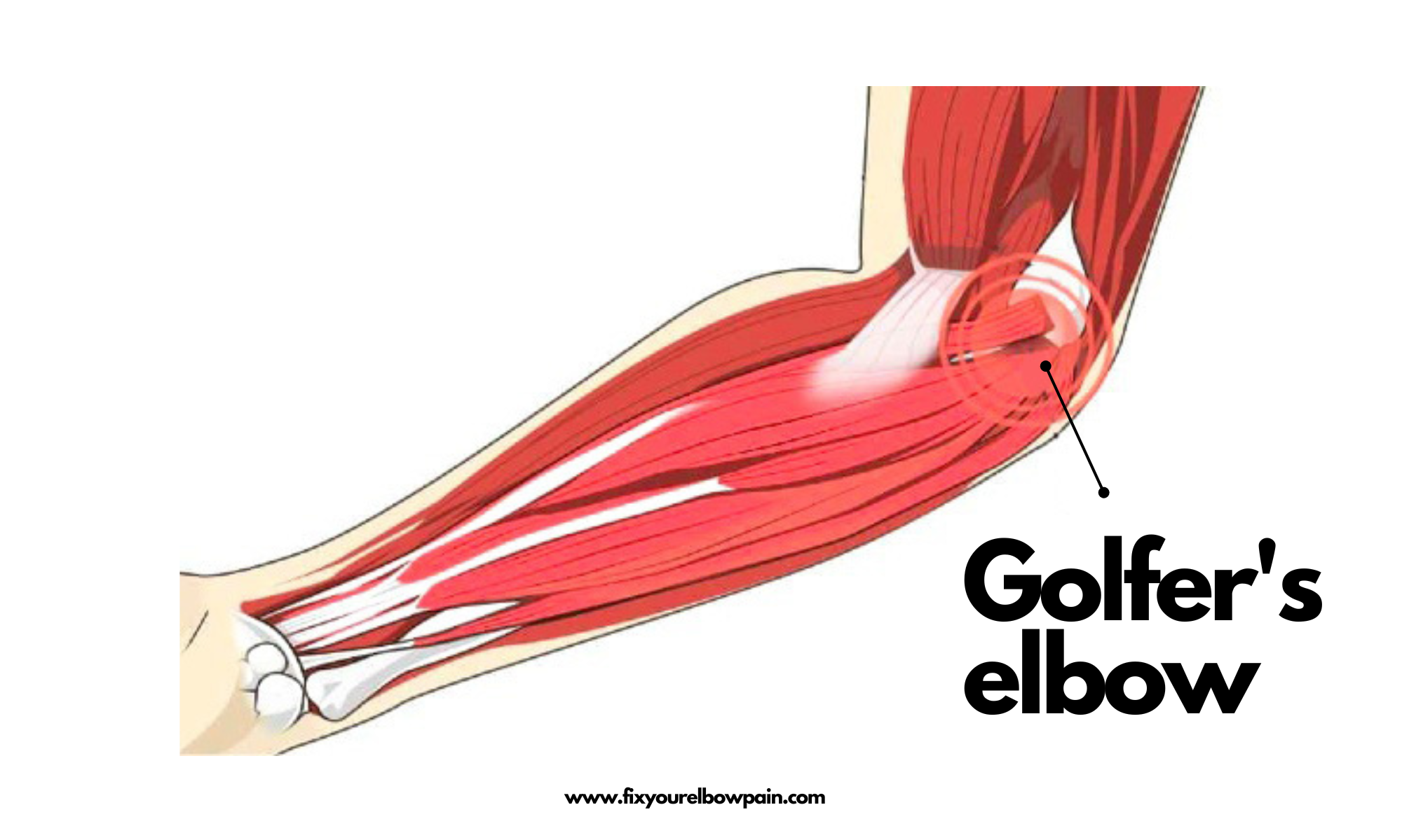 What is a golfer's elbow? Fix your elbow pain